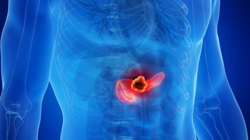 Medical illustration of a human torso highlighting a tumor in the pancreas in the abdomen.